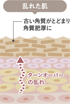 角質肥厚の肌イメージ 乱れた肌